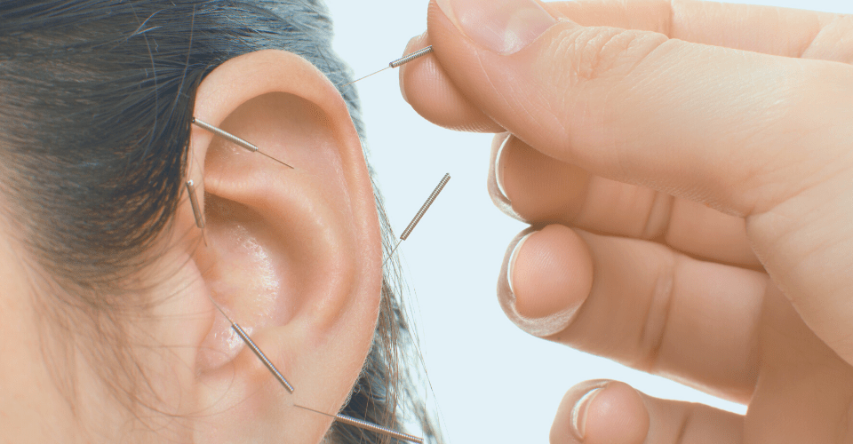 Acupunctuur: de naalden die je laten ontspannen en energie geven!